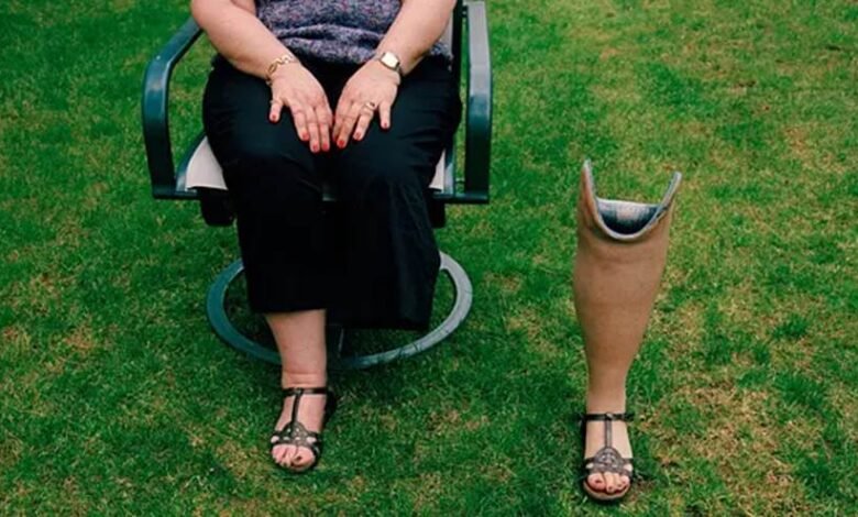 New Advances Show Amputation Isn’t the Only Option for Bone Cancer