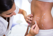 What Can a Tummy Tuck in Dubai Do for You?