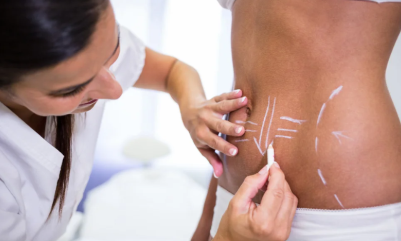 What Can a Tummy Tuck in Dubai Do for You?